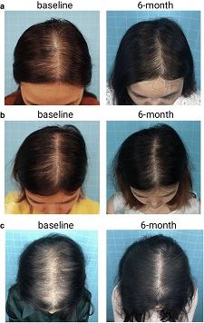 Hair growth after minoxidil stabilization Hair growth after minoxidil stabilization