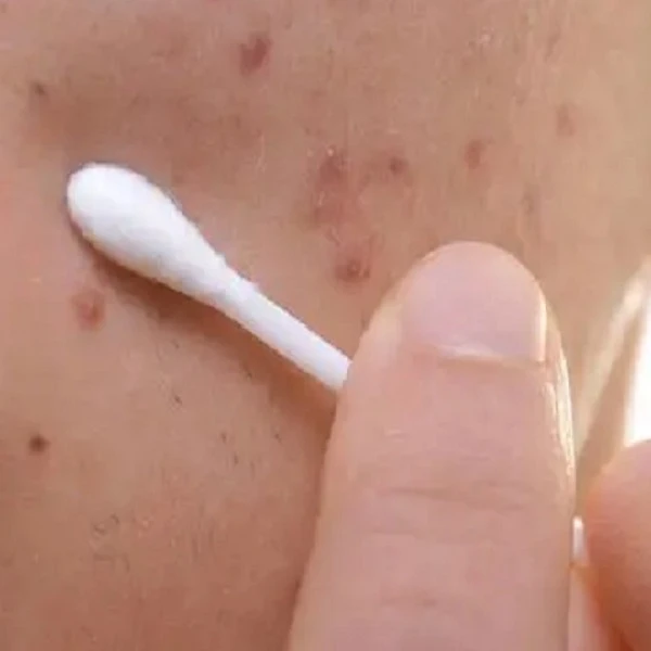 How to use clindamycin phosphate gel How to use clindamycin phosphate gel