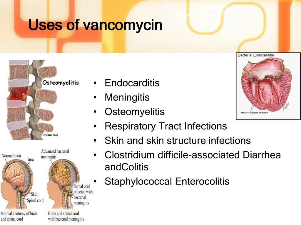 uses of Vancomycin uses of Vancomycin