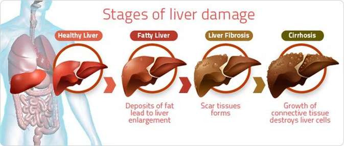 TUDCA is used to treat gallstones and cirrhosis TUDCA is used to treat gallstones and cirrhosis